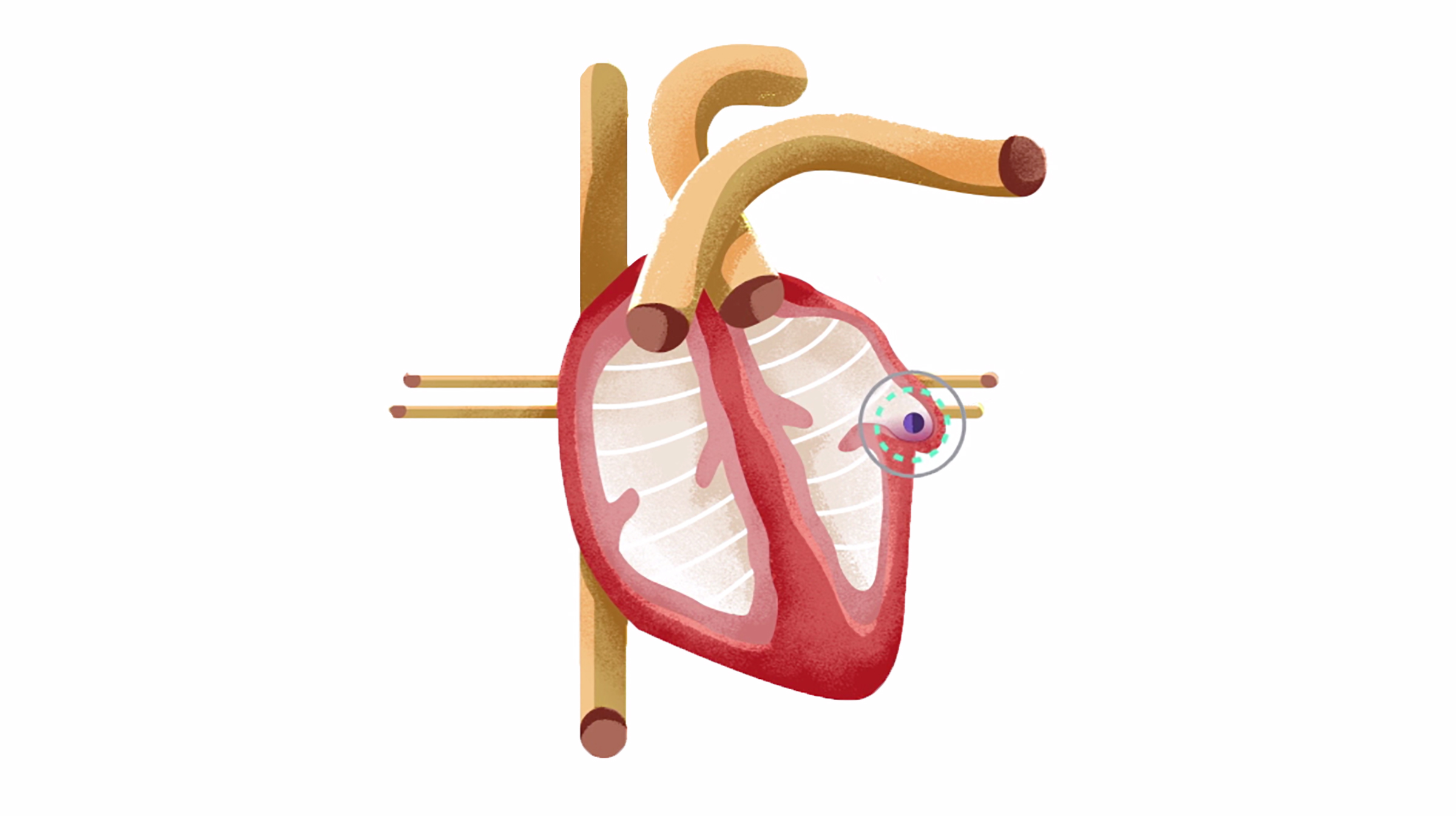 An anatomical illustration of the heart, with a blue dash circle around the location of a left atrial appendage occlusion.
